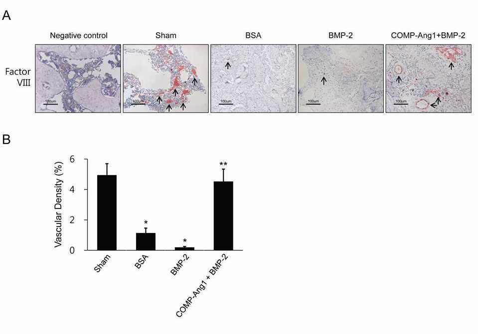 Immunohistochemical staining for factor VIII-related antigen and vascular densities in infarcted femoral heads.