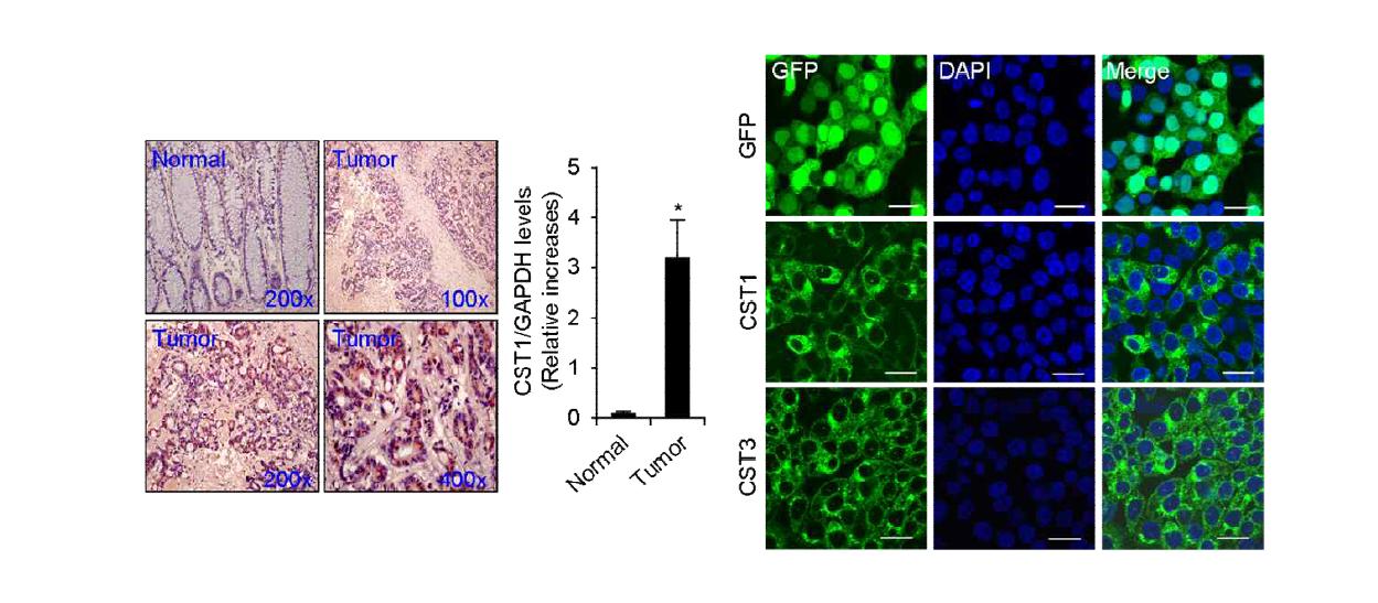 대장암 환자의 조직 및 세포주에서의 CST1의 단백질 발현 수준을 확인함.