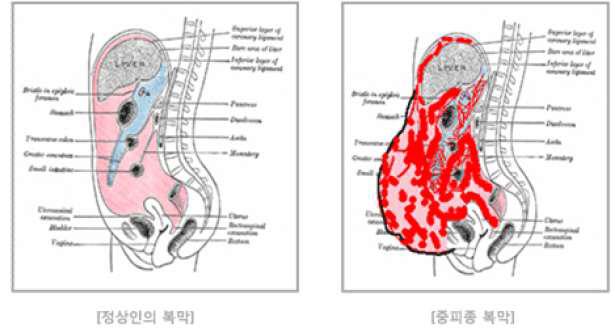 정상인과 중피종에 걸린 사람의 복막 비교 사진
