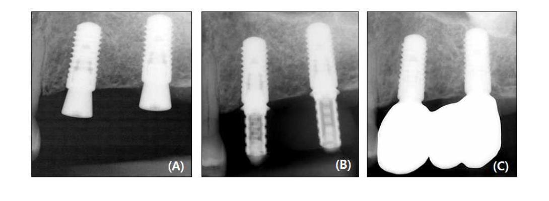 Standard periapical radiographs of implants placed in a patient in the control group
