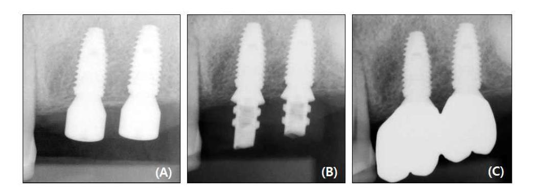 Standard periapical radiographs of implants placed in a patient in the experimental group