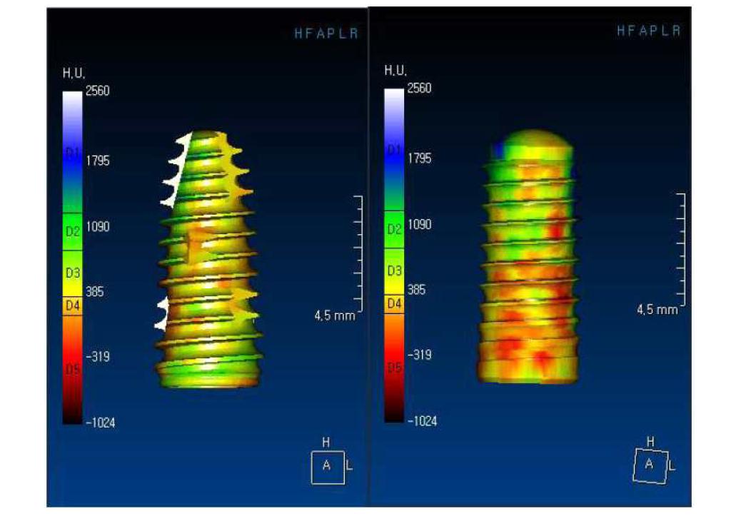 Three-dimensional images of implants showing bone types and corresponding Hounsfield units, generated by OnDemand® software (Cybermed, Seoul, Korea): (left) CMI implant and (right) SLActive implant