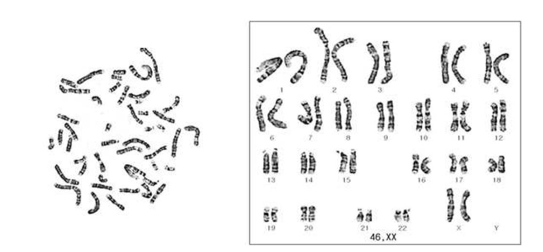핵형검사 결과