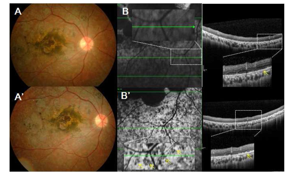 SMD 피험자(B) 52주 경과 후 안저 촬영(A), 스펙트럼 영역 빛 간섭단층 촬영(B) 검사 결과