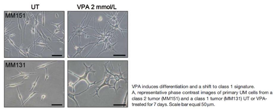 VPA의 uveal melanoma 증식 저해 효과
