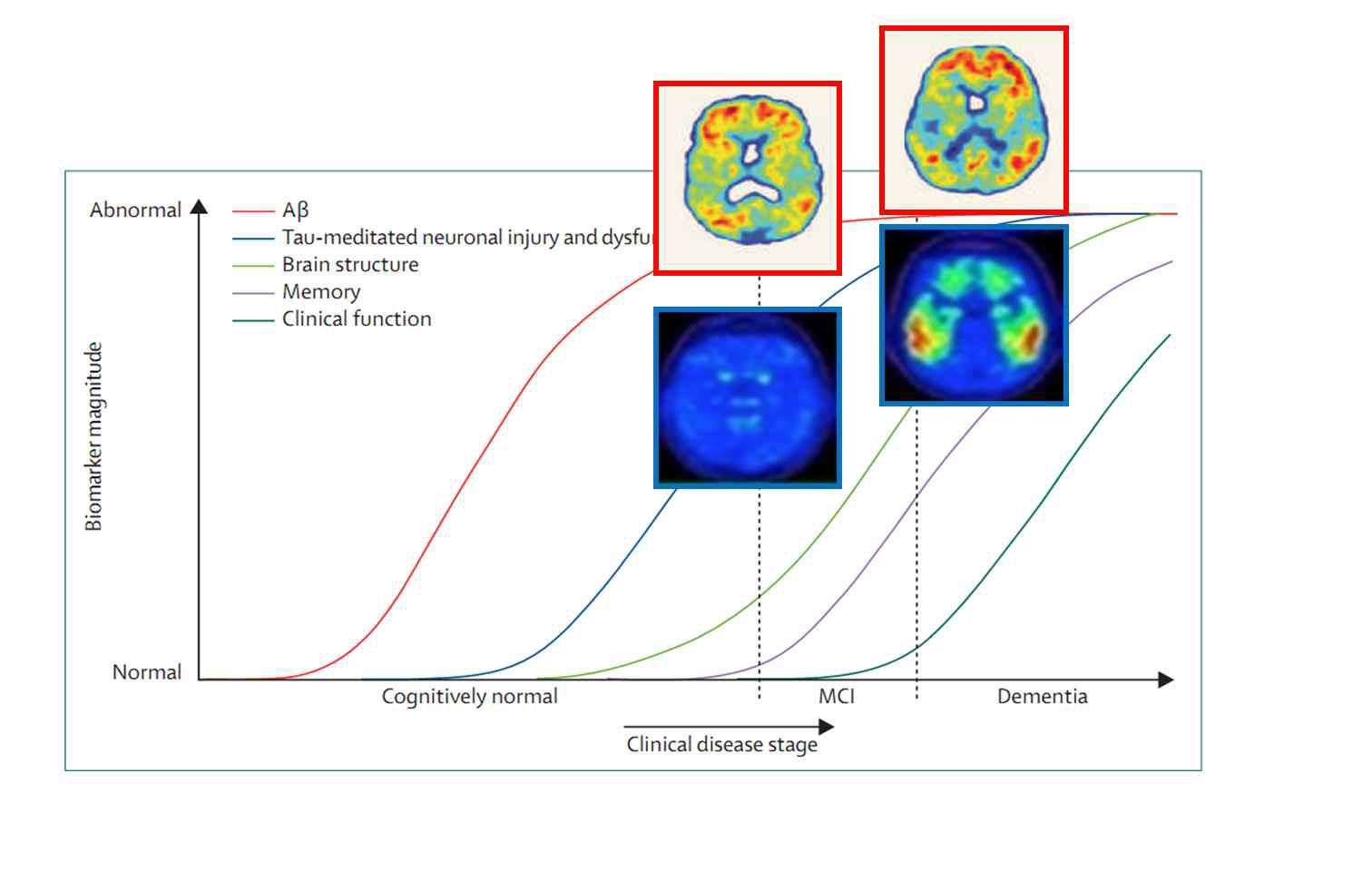 경도인지장애 및 치매 초기에 아밀로이드베타의 침착은 큰 변화가 없으나(빨간 상자), 타우단백의 침착은 변화폭이 큼(파란 상자).