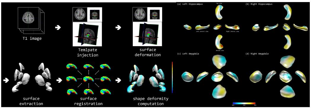 MRI의 hippocampus와 amygdala의 shape analysis를 이용한 아밀로이드 예측. Kim HJ. et al. PlosOne (2013)