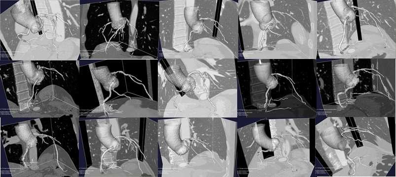심장부위 의료영상데이터로부터 분할된 3차원 관상동맥 영상