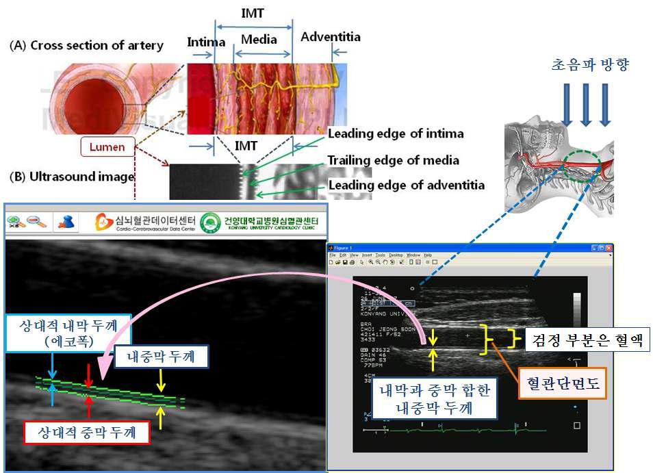 A cross section of carotid artery (A) and the ultrasound image acquired from the far wall of the common carotid artery (B).