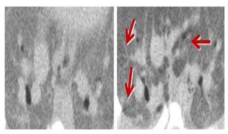 Micro CT finding [left; control, right treated]