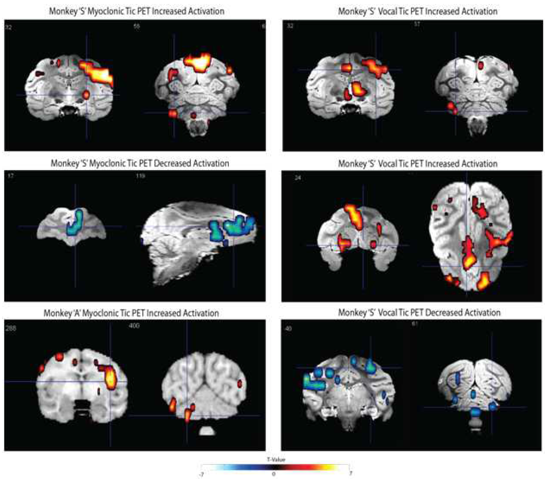 15O-PETimagingdataduringmyoclonicandvocaltics