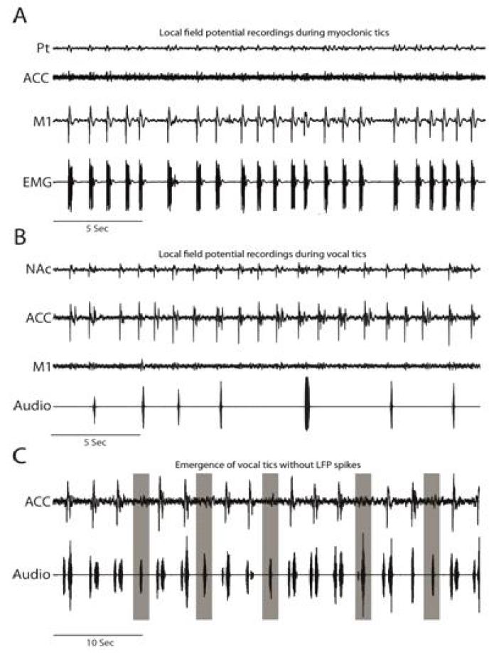 Emergence of LFP spikes across functionally segregated BG-cortico recipient regions.