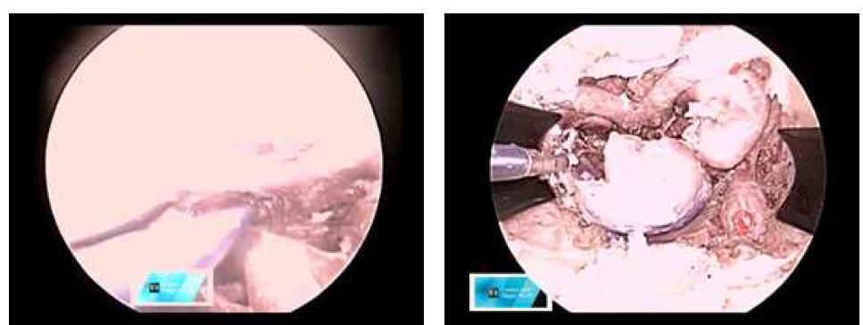 forcep을 이용한 생체조직 dissection