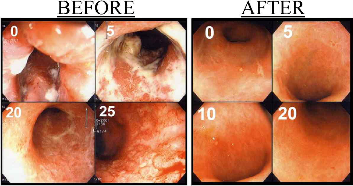 궤양성 장염(Ulcerative colitis)을 앓고 있는 환자의 대장 내시경