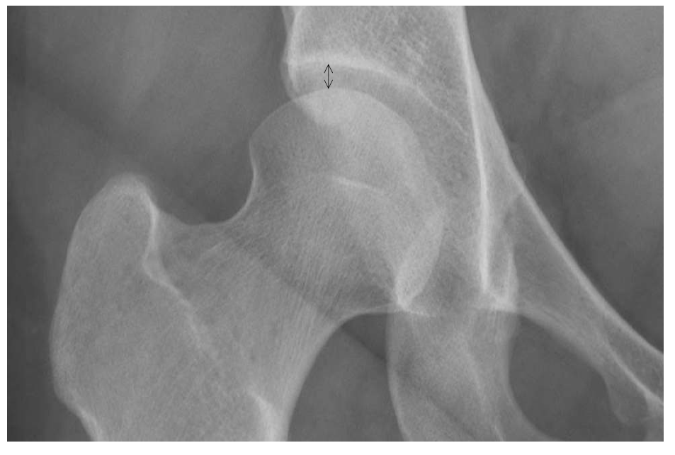 Method of measuring the thickness of articular cartilage in plane AP radiograph