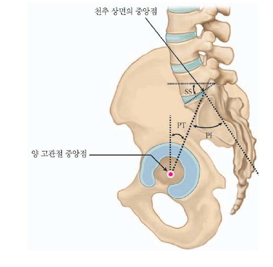 Schematic drawing of measuring a pelvic incidence