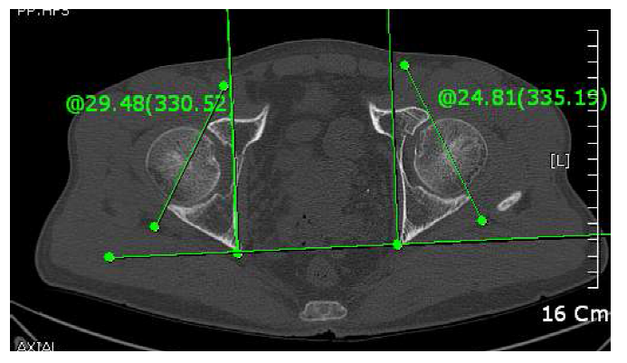 Method of measuring an acetabular anteversion in CT axial image