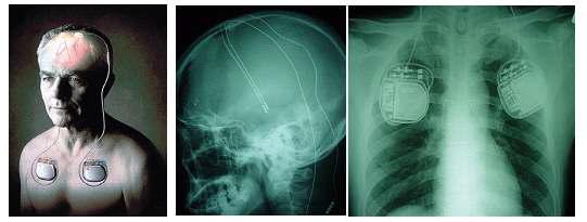 뇌심부자극술 (DBS: Deep Brain Stimulation)의 모식도