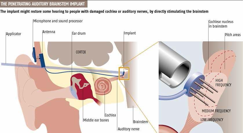 뇌간에 삽입된 auditory brainstem implant.