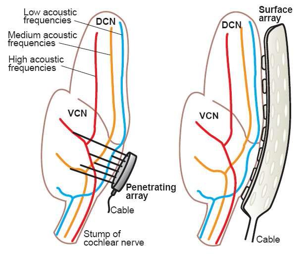 뇌간의 주파수별 지도와 auditory brainstem implant의 두 예(삽입형(좌)과 접촉형(우)).