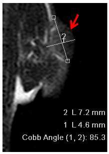 종양의 크기를 측정한 3.0T MRI 사진