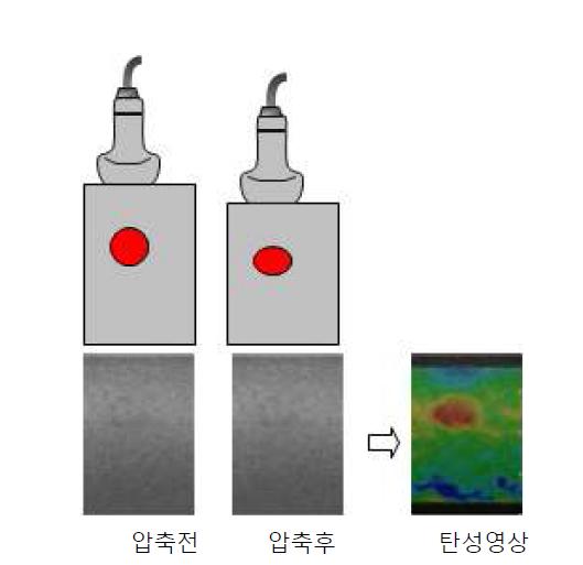 정적 초음파 탄성영상법