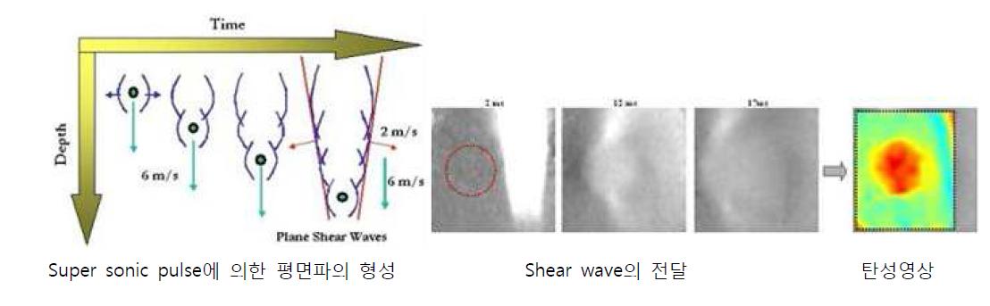 Supersonic 초음파 탄성영상법