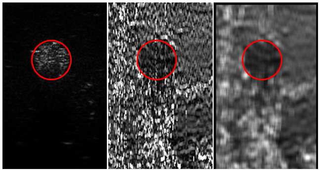 일반 초음파 영상(좌), 탄성 영상(중), 잡음처리 후 탄성 영상(우)