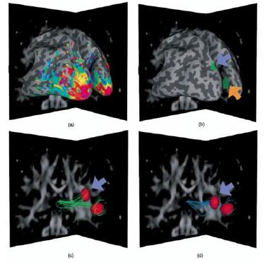 Exploring connectivity of the Brain’s white matter with dynamic queries, IEEE Trans on Visualization and Computer Graphics, 2005