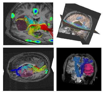 Non-rigid alignment of pre-operative MRI, fMRI, and DT-MRI with intra-operative MRI for enhanced visualization and navigation in image-guided neurosurgery, NeuroImage, 2007