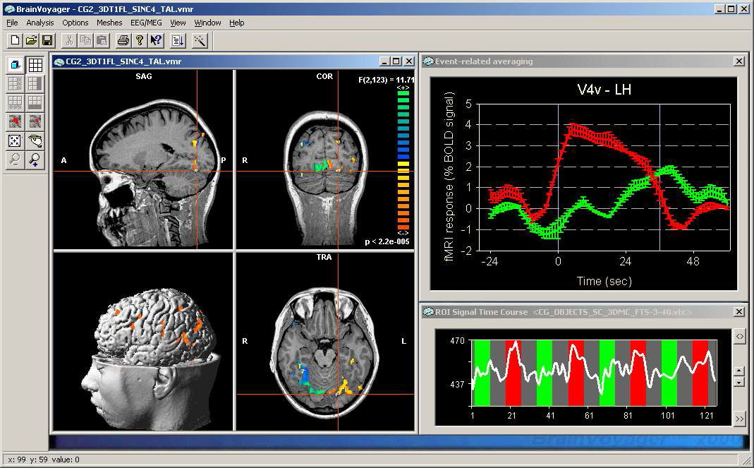 MRI와 EEG의 가시화 (BrainVoyager)