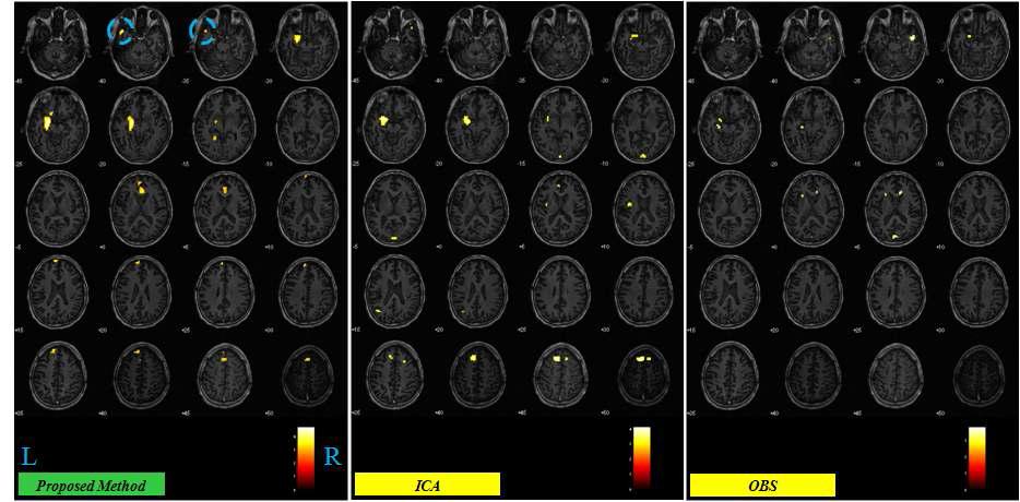 제안하는 방법을 사용하여 획득한 간질환자의 fMRI 데이터 분석결과