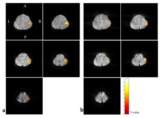 제안하는 방법을 사용하여 획득한 fMRI 결과 영상