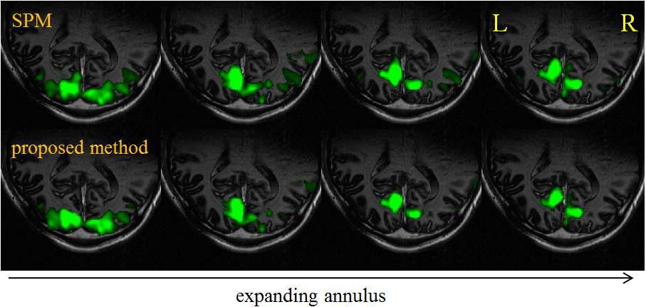 Statistical parametric mapping (SPM) 방법과 제안하는 방법의 비교