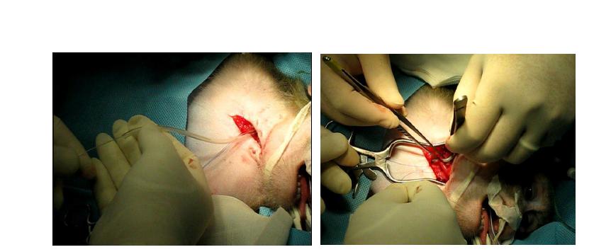 Positioning of the ballooning catheter