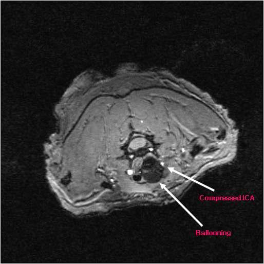 Normal saline (1.2cc) infusion resulted in partial obstruction of right ICA