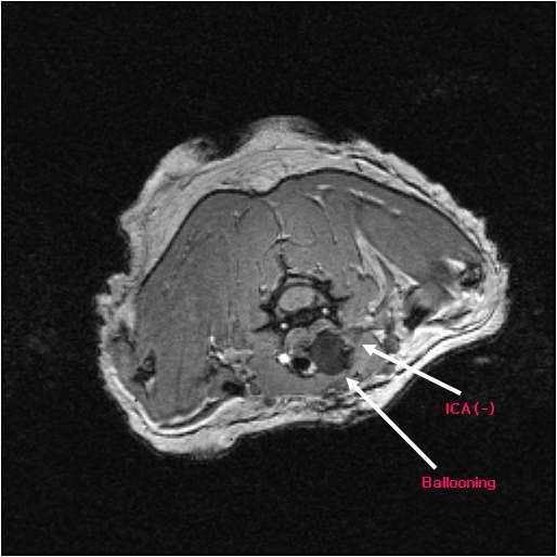 Normal saline (1.5cc) infusion resulted in full obstruction of right ICA