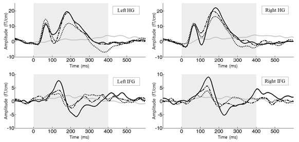 헤쉴과 하측두영역에서의 초기 음극성 뇌파의 조건별 비교