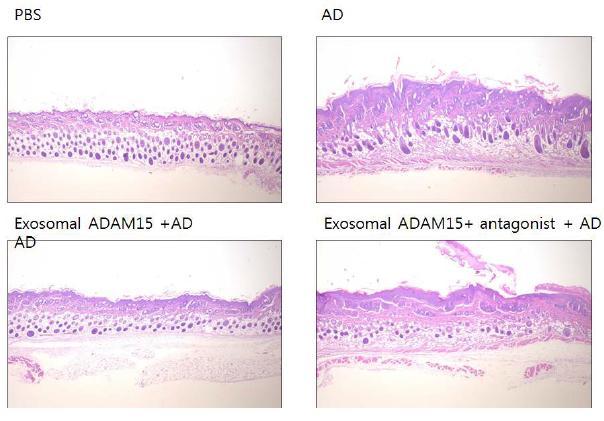 Exosomal ADAM 15에 의한 AD skin의 변화조절