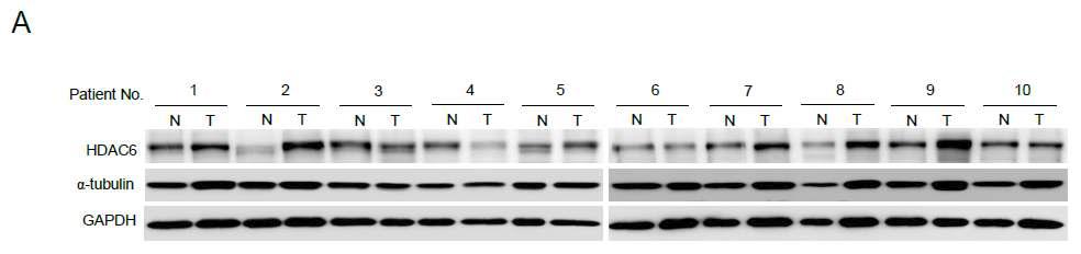 위암 조직에서 HDAC6의 단백질 발현 양상