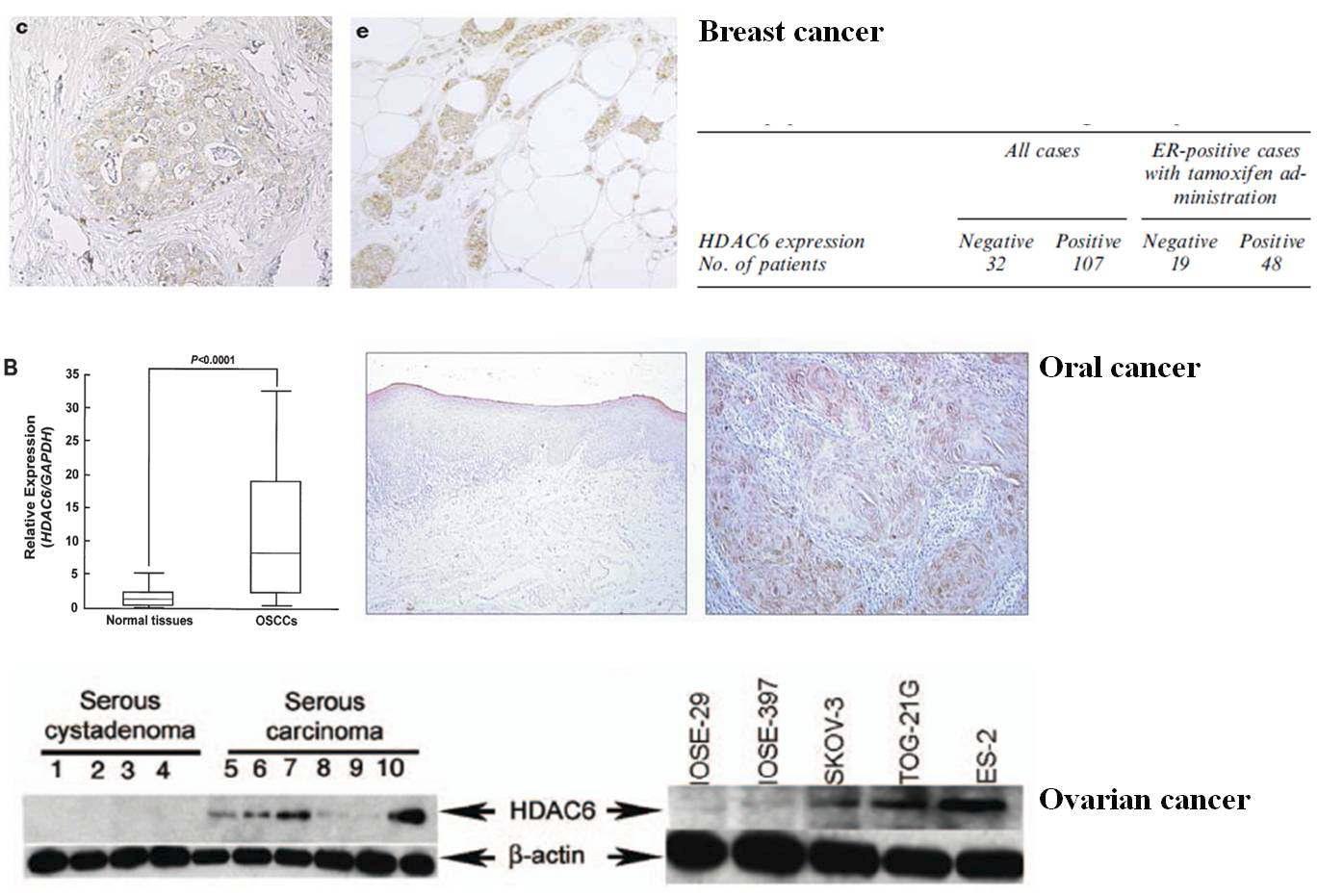유방암, 구강암 및 난소암에서의 HDAC6의 발현 양상