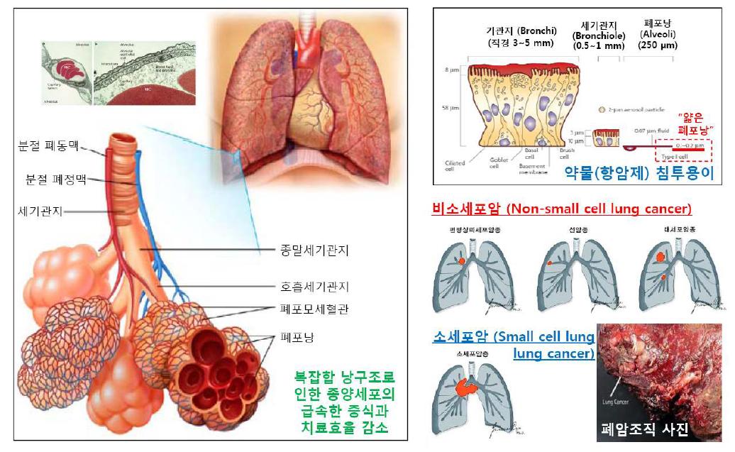 폐의 구조 및 폐암의 종류와 특징