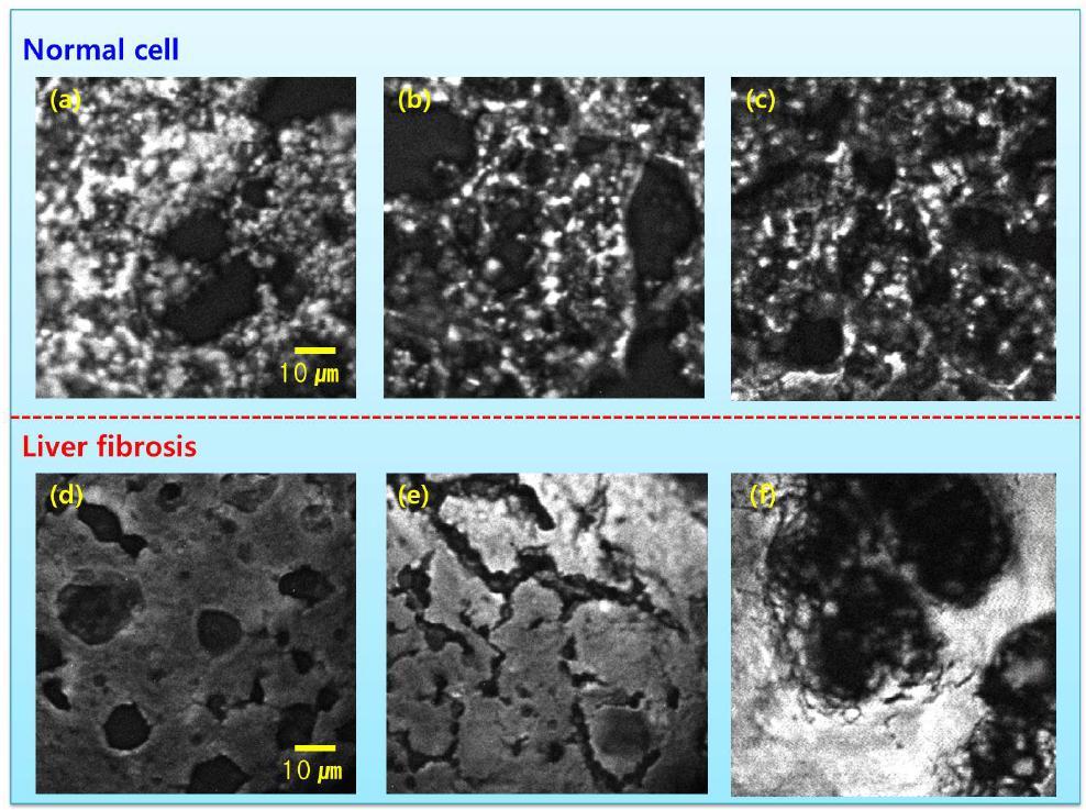 정상과 간섬유화 조직의 대표적인 CARS 이미지.