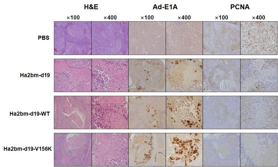 Histological analysis of tumor area at 3 days post final injection by hematoxylin and eosin (H & E) staining. Particles of adenovirus (Ad) in the tumor area were visualized by immunohistochemistry using the antiAd E1A antibody. Proliferating cell nuclear antigen (PCNA) was visualized by immunodetection using mouse anti-PCNA antibody