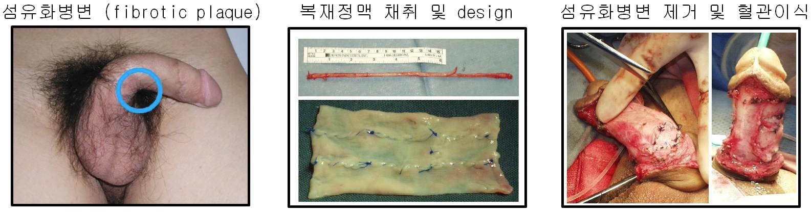 음경만곡증의 수술적 치료