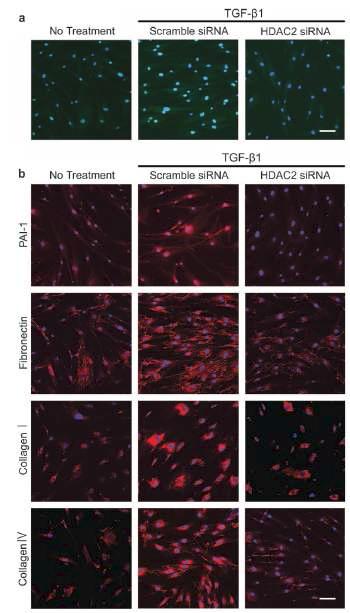 음경만곡증 환자의 섬유화병변에서 분리된 섬유모세포에서 HDAC2 siRNA로 인해 HDAC2 의 knockdown을 유도 후 면역형광염색으로 확인(a). ECM protein, 즉 PAI-1, fibronectin, collagen Ⅰ, collagen Ⅳ의 발현이 TGF-β1 처리 후 현저하게 증가하였고, TGF-β1 신호전달에 의한 extracellular matrix protein의 발현를 성공적으로 억제함(b).