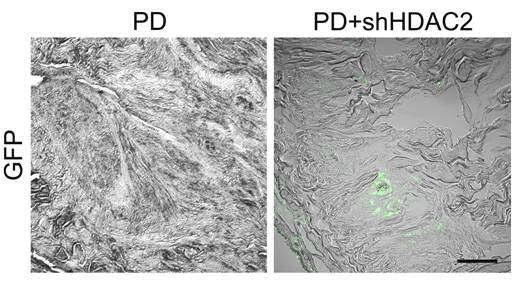 국소 투여한 HDAC2 shRNA의 발현양상 관찰. GFP가 tagging 되어 있는 HDAC2 shRNA를 음경백막의 섬유화 병변에 투여한 후 15일 째 (day 30) 발현여부를 관찰한 결과, GFP의 발현이 음경백막 근처에서 남아 있음이 확인됨. PD, Peyronie’s disease (페이로니병/음경만곡증).