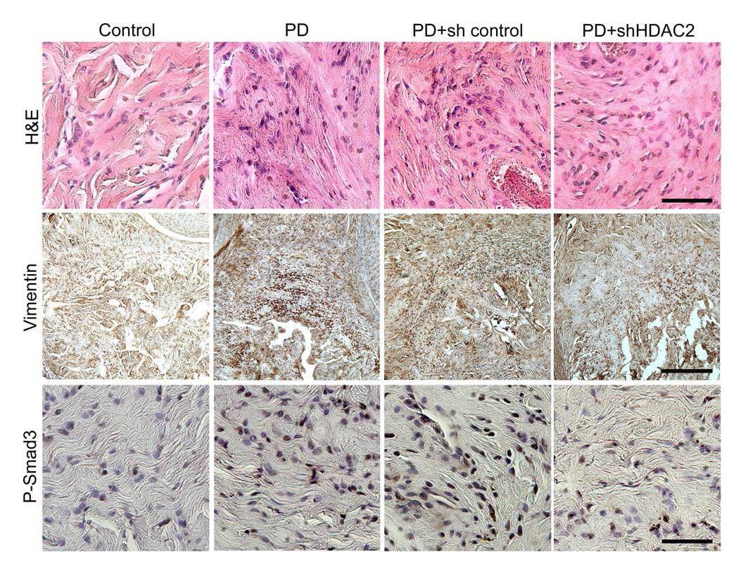 HDAC2 shRNA 투여로 인한 섬유화 병변의 변화를 확인함. Hematoxylin-Eosin 염색을 통하여 lymphocyte infiltration, Vimentin 염색을 통하여 fibroblast infiltration, phospho-Smad3 염색을 통하여 TGF-β 하위신호전달 인자로서 섬유화작용에 중요한 역할을 하는 phospho-Smad3 발현이 감소함을 규명함.