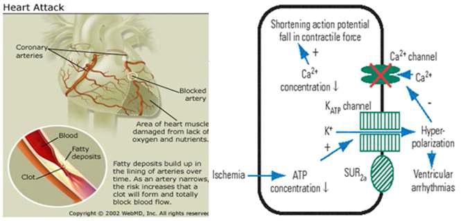 Heart attack-Ischemic condition