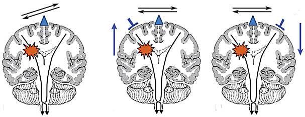 뇌졸중 이후 나타나는 양쪽 대뇌 신경흥분도의 불균형(좌)과 이를 줄이기 위한 두 가지 접근 방법; 병변측 신경활성 촉진(중) 및 병변반대측 신경활성 억제(우)
